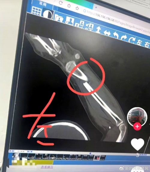 河南洛阳:违规操作致危化品运输罐车爆燃致人重伤无人问津?(图3)